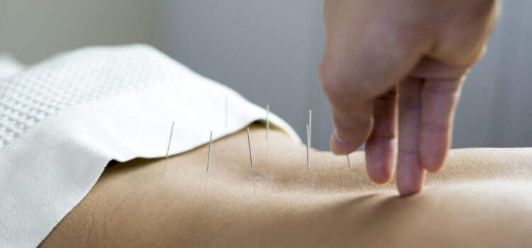 Dry Needling