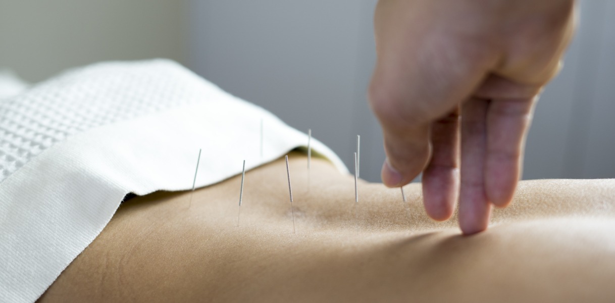 Dry Needling